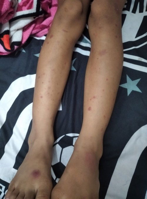 Timbul bercak merah pada kaki dan tangan tapi gatal