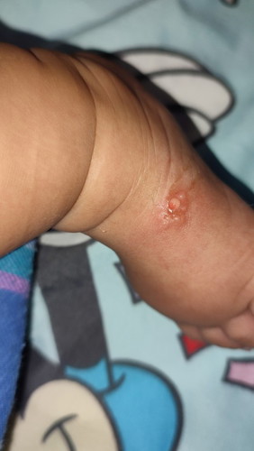 Insect bites