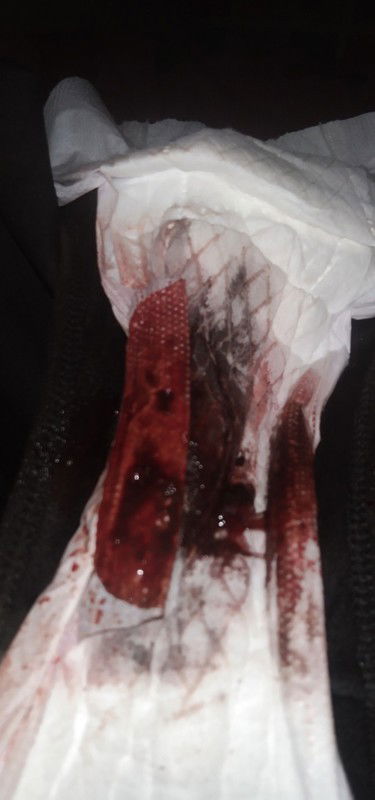 แบบนี้เรียกว่าแท้งไหมค่ะแม่ๆ พอดีว่าท้องได้5สัปดาห์แล้ว แต่อยู่ๆก้อมีเลือดออก เป็นวุ้นๆตั้งแต่เช้าคะ