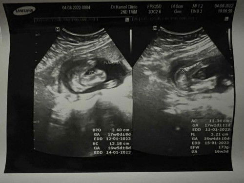 ดูเพศในภาพอัลตราซาวด์