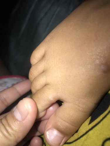 Bentol berair pada kaki