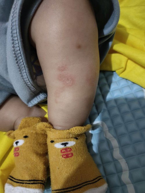 Ruam di kaki bayi