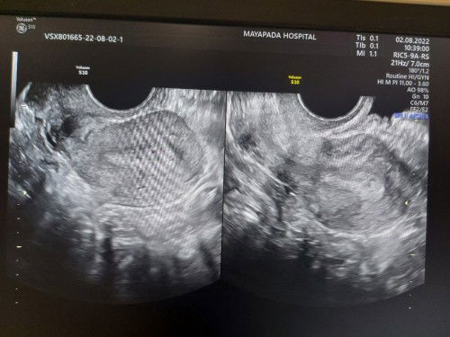 Telat haid 10 hari testpack kadang samar kadang negatif, belum keliatan apa apa di transvaginal