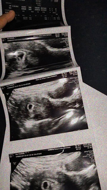 Complete Miscarriaged