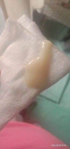 Mga momshi Ask ko lang po kung ano po ito 31weeks palang po ako. Natural lang poba ito sa buntis?
