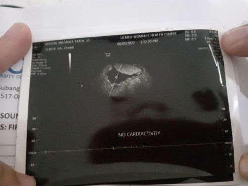 within a poorly dicidualized gestational sac is an embryo with no cardiac activity seen yet