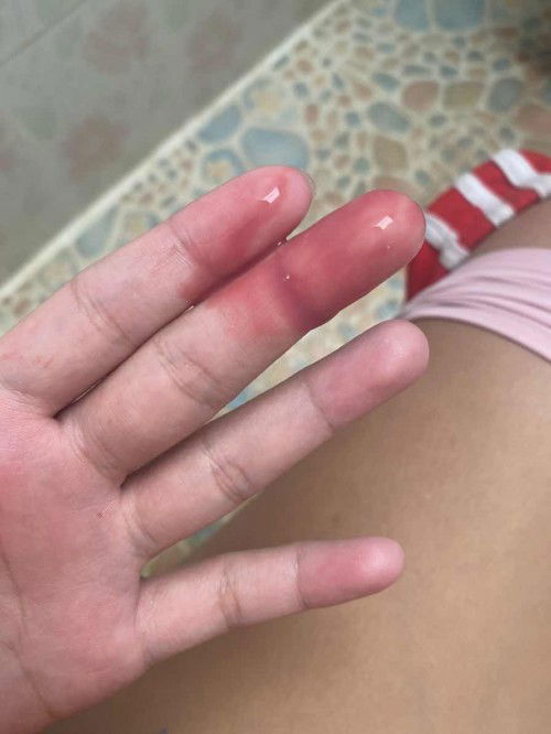 ท้อง 19 w มีเลือดออกเป็นสีชมพู