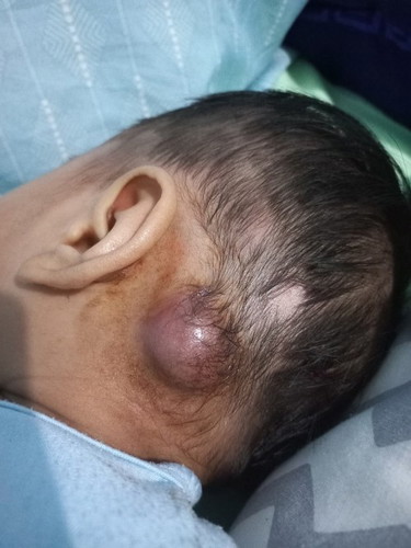 Anak saya sedang bisulan dan ada 1 bisul yang tidak kunjung bermata, bagaimana mengatasinya mom?