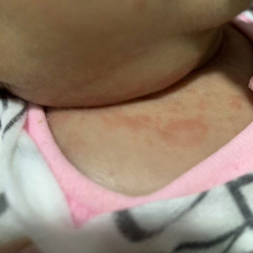 Suggest cream apa best untuk ruam di leher bayi?