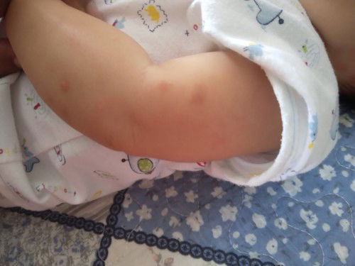 ลูกโดนยุงกัด