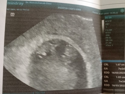 ตั้งครรภ์แฝด