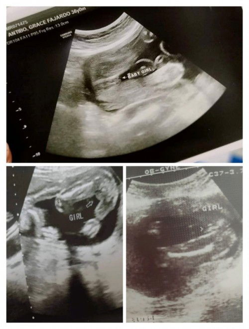 3x ultrasound