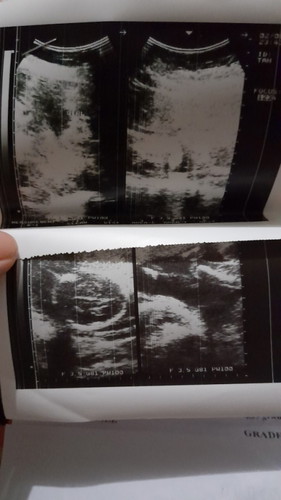 Pag nagultrasound ng 5months sure naba ang gender hindi na po ba magkakamali? Ang labo po kasi eh.
