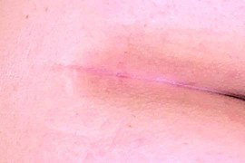 PURPLE LINE DILATION