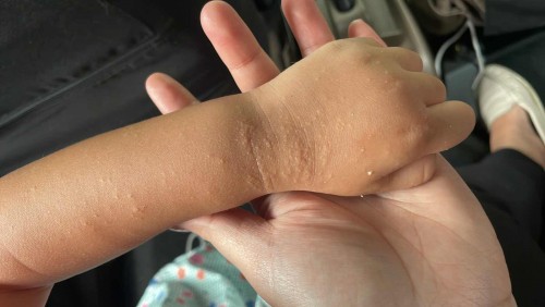 3yo rashes