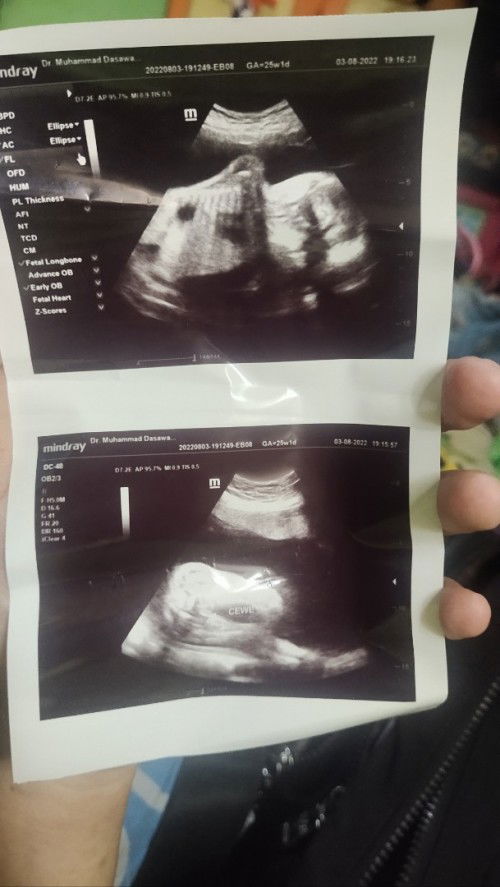 Keakuratan USG berapa persen