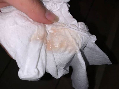 Meron po ba naka experience ubuhin ng sobra (due to dry cough & itchy throat) and nag spotting?