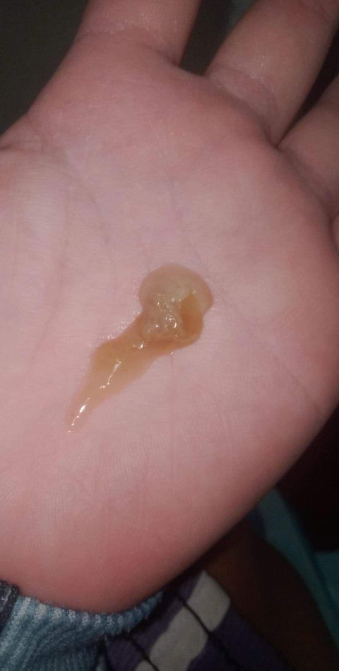 แบบนี้คืออะไรค่ะแม่ๆไม่มีอาการไรเลยค่ะ