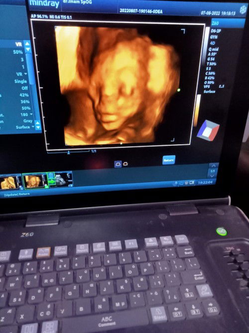 Bun wajar gak sih HPL beda