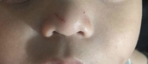 May kalmot baby ko sa ilong, hindi ko alam if sya mismo nakakalmot or yung mga dogs namin,