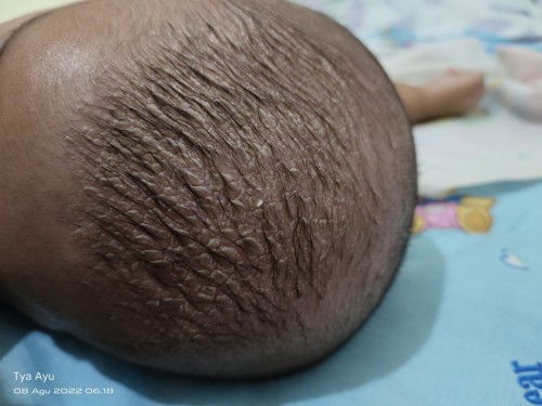 ini kenapa ya kemarin sudah di bawa di dsa di kasih cream noroid tapi gak sembuh malah tambah kering