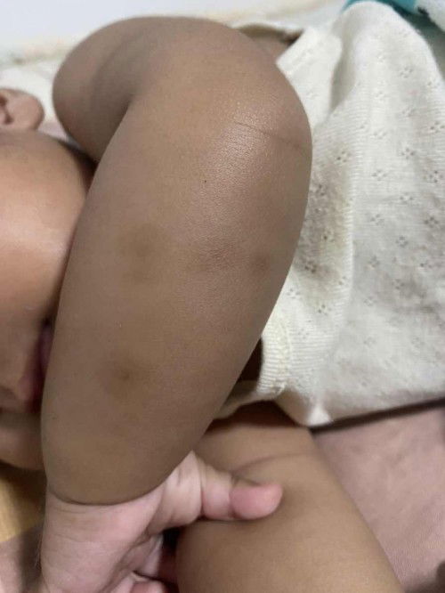 รอยดำจากมดกัดยุงกัดใช้อะไรทาถึงจะหายคะ