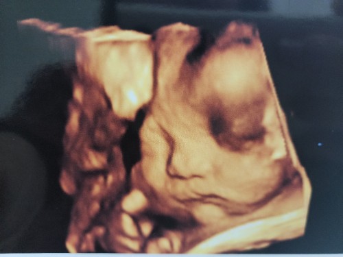 Ultrasound pic