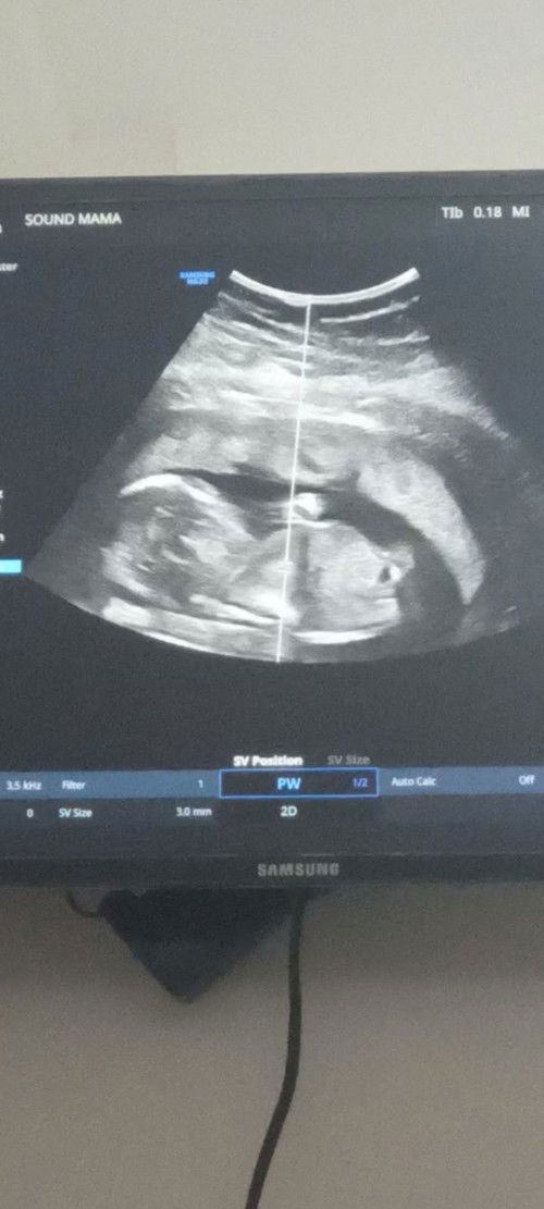 Can't wait sa gender ni Babyyy 🥰❤️