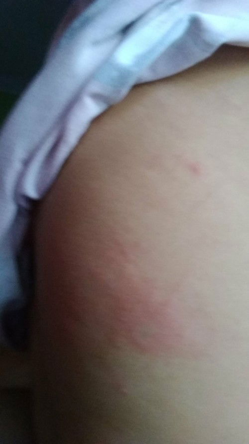 Punggung merah seperti herpes