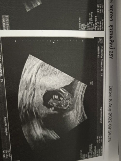 มีใครเห็นเป็นจู๋บ้างค่ะ หมอบอกเห็นแค่ปลายจู๋ยังไม่เห็นไข่เลยไม่ฟันธงว่าน้องเป็นผช