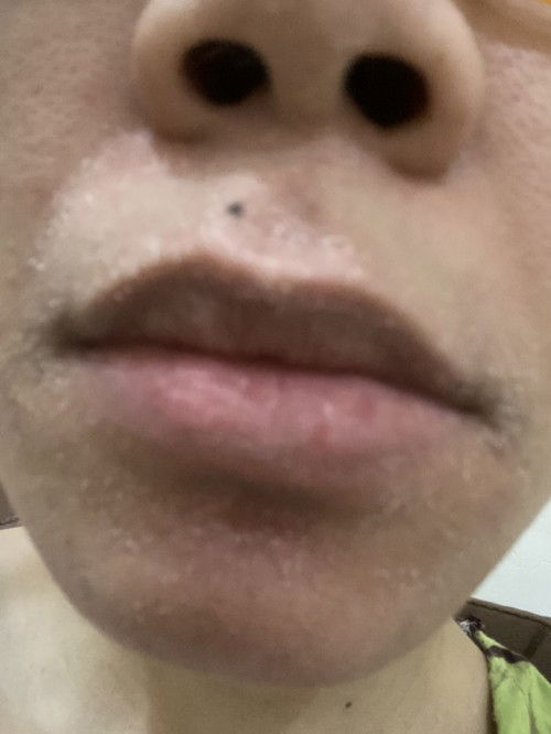 Kulit Kering Sekitar Mulut