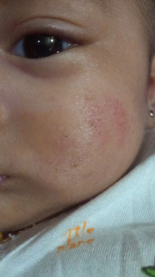 Moms maap ini pipi anak saya kenapa yah,, ada yang tau obatnya gak kasian kaya gatal gatal