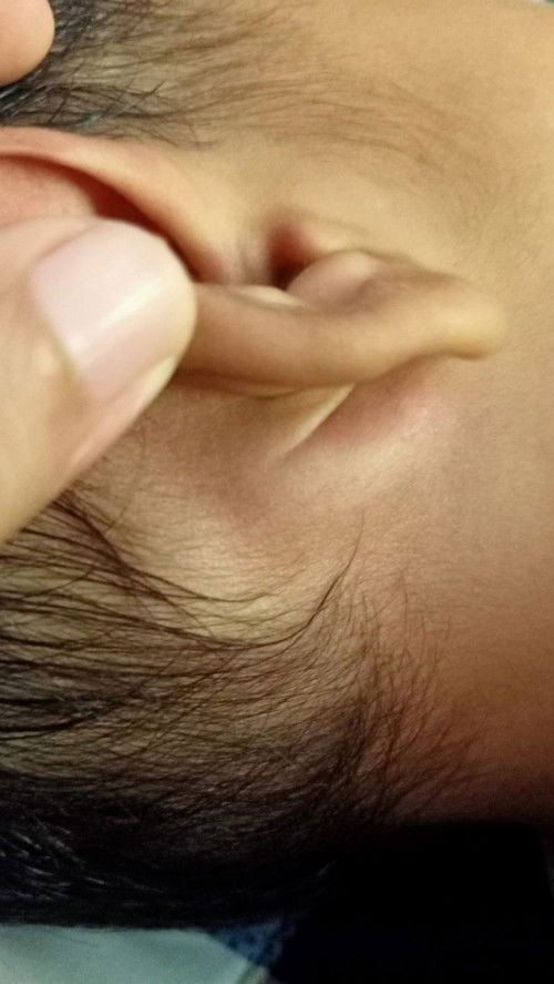 ลูกมีก้อนบวมแดงหลังใบหูกดแล้วเจ็บ