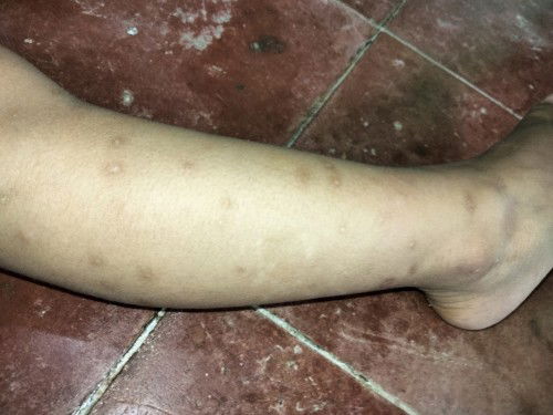 Bekas gigitan nyamuk