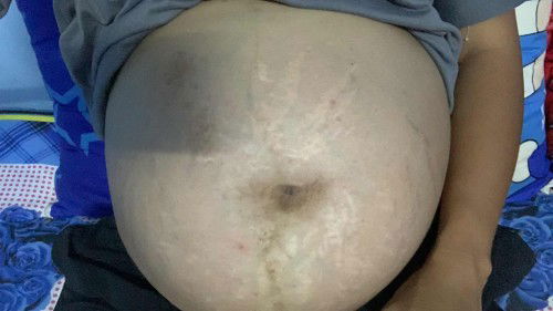 35+6 วัน ท้องปั้น แข็ง