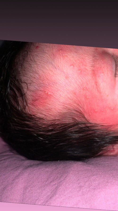 Muka bayi ada bintik2 dan merah