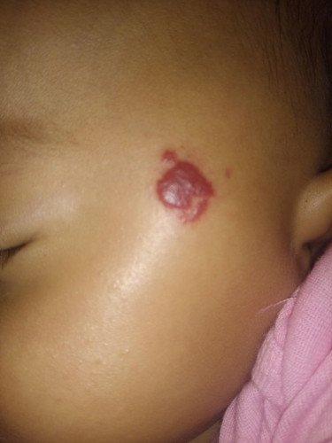 Hemangioma