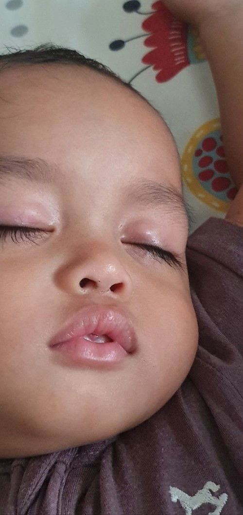 Kelopak mata seperti bintitan tp tdk ada mata