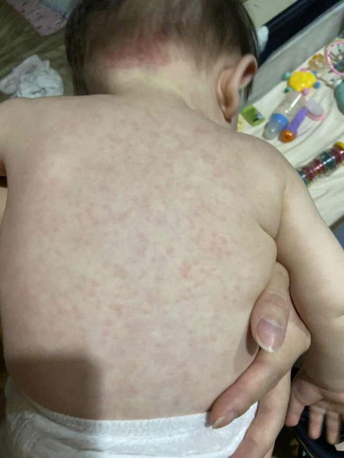 ลูกเป็นไข้สูง3วันหลังจากนั้นขึ้นผื่นเต็มตัว