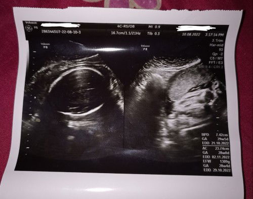 Hasil USG jenis kelamin