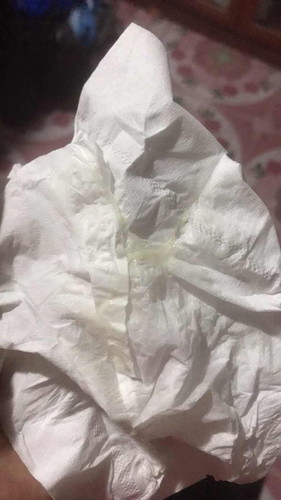 35w1d แม่ๆเป็นเเบบนี้เขาเรียกว่าอะไรคะ
ต้องไปหาหมอหรือเปล่า?