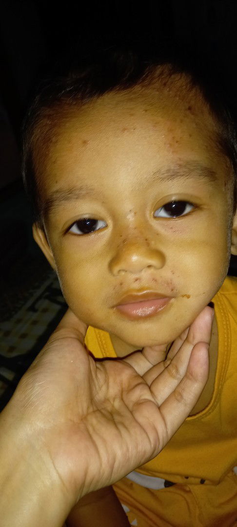 Ruam wajah pada anak