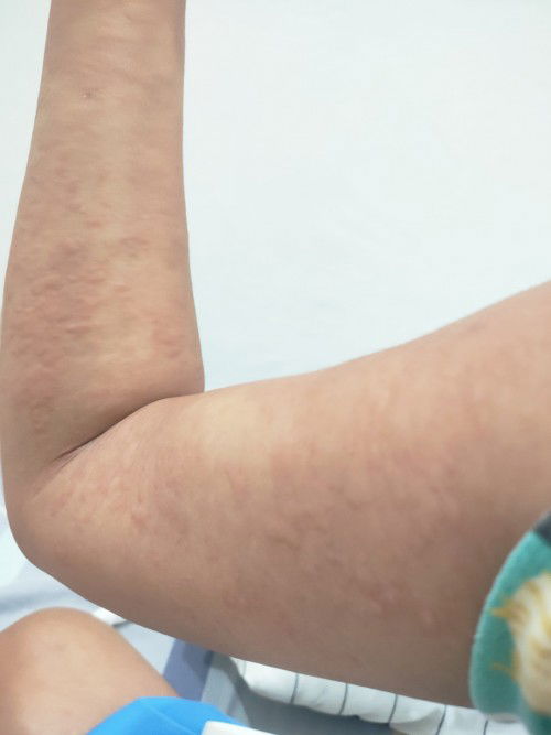 Pupp rash any idea mommies?