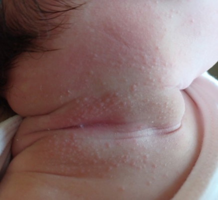 How to get rid of rashes around 3-4 months old baby's neck?