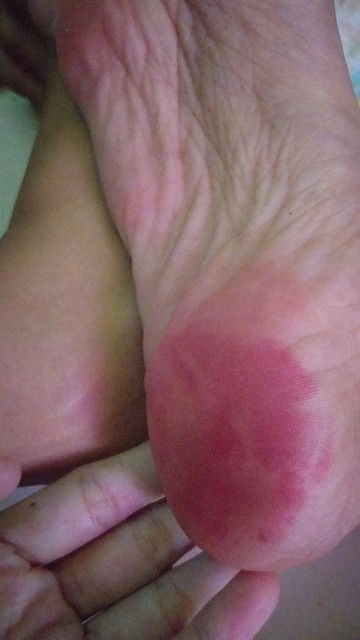 Telapak kaki bawah merahh