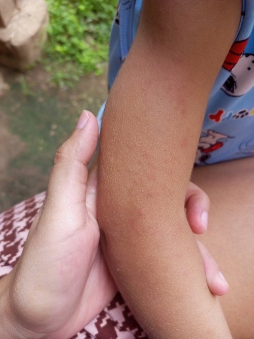 Tigdas po ba kaya ito?