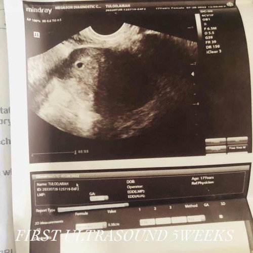FTM NO EMBRYONIC POLE NOTED