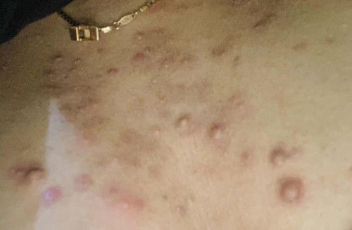 Di dada tumbuh seperti keloid dan jerawat