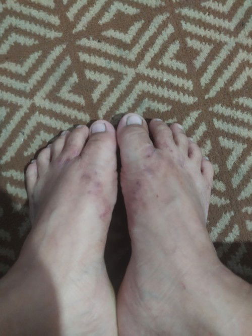 Gatal" Pada kaki saat trimester ke 3