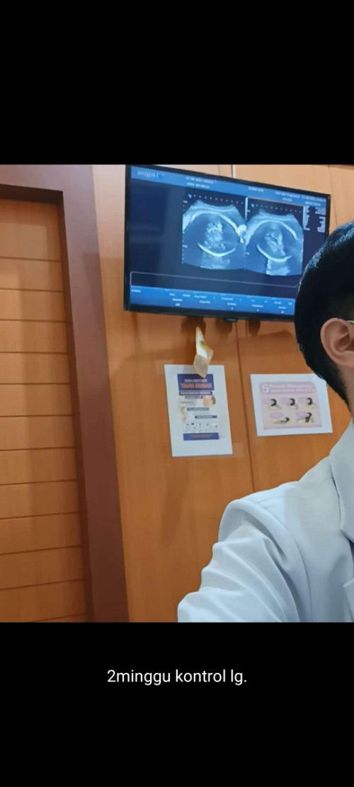 Cara mengatasi masalah posisi sungsang.................